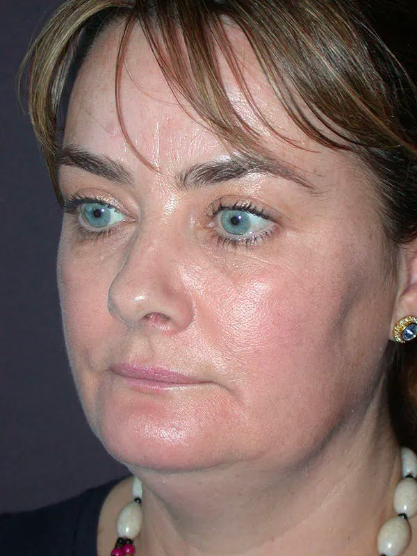 Neck Lift Before & After Gallery - Patient 40633466 - Image 5