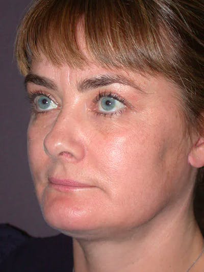 Neck Lift Before & After Gallery - Patient 40633466 - Image 6