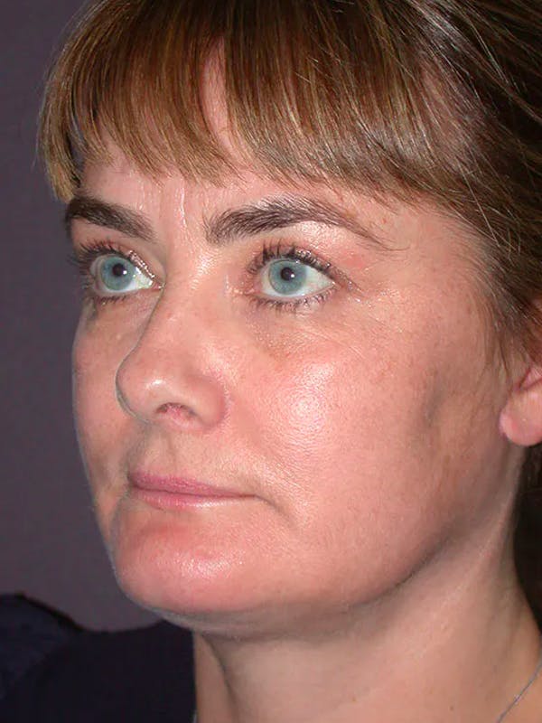 Neck Lift Before & After Gallery - Patient 40633466 - Image 6