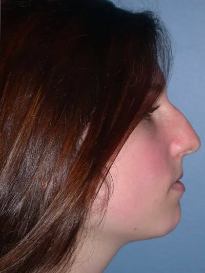 Rhinoplasty Before & After Gallery - Patient 4757144 - Image 1