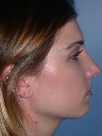 Rhinoplasty Gallery Before & After Gallery - Patient 4757144 - Image 2