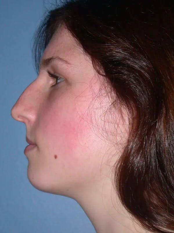 Rhinoplasty Gallery Before & After Gallery - Patient 4757144 - Image 3