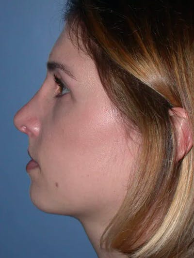 Rhinoplasty Gallery Before & After Gallery - Patient 4757144 - Image 4