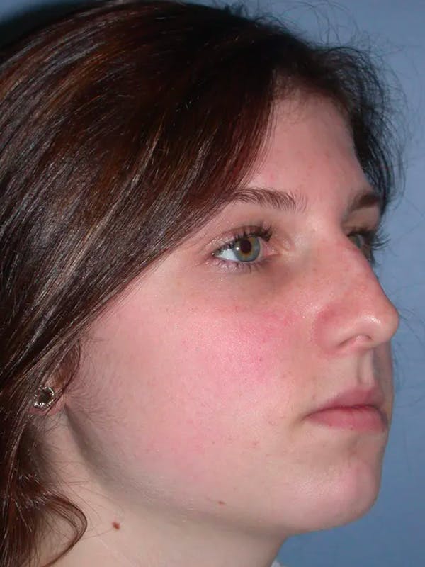 Rhinoplasty Gallery Before & After Gallery - Patient 4757144 - Image 5