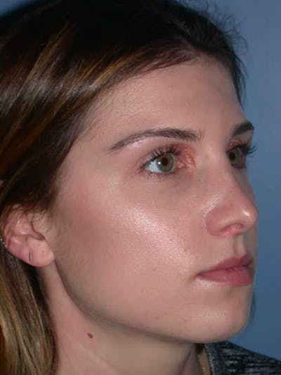 Rhinoplasty Gallery Before & After Gallery - Patient 4757144 - Image 6
