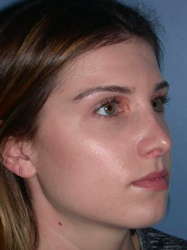 Rhinoplasty Before & After Gallery - Patient 4757144 - Image 6