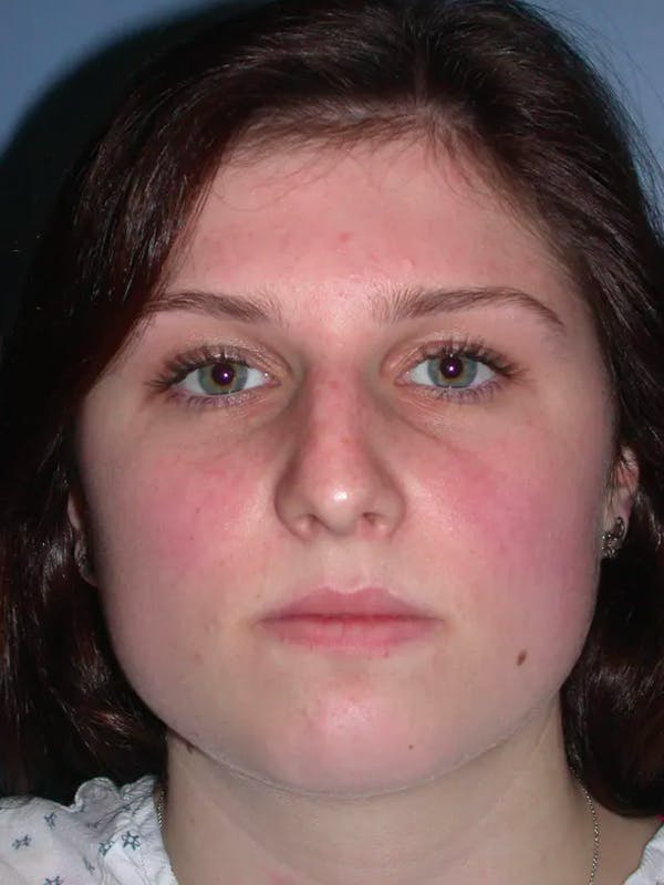 Rhinoplasty Gallery Before & After Gallery - Patient 4757144 - Image 7