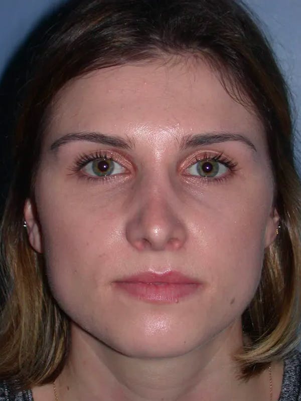 Rhinoplasty Gallery Before & After Gallery - Patient 4757144 - Image 8