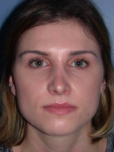 Rhinoplasty Before & After Gallery - Patient 4757144 - Image 8