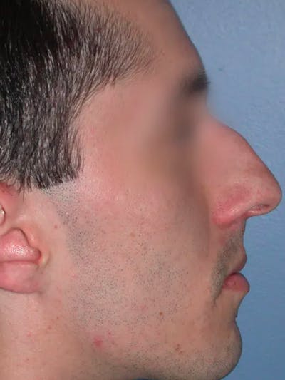 Rhinoplasty Before & After Gallery - Patient 4757165 - Image 1