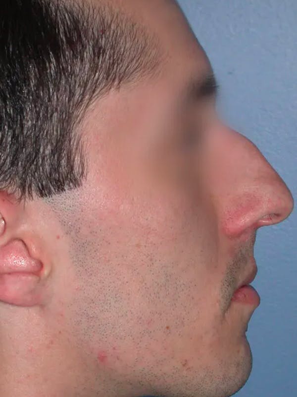 Rhinoplasty Before & After Gallery - Patient 4757165 - Image 1
