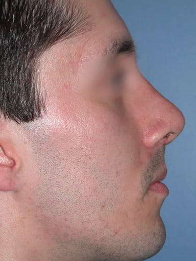 Rhinoplasty Before & After Gallery - Patient 4757165 - Image 2