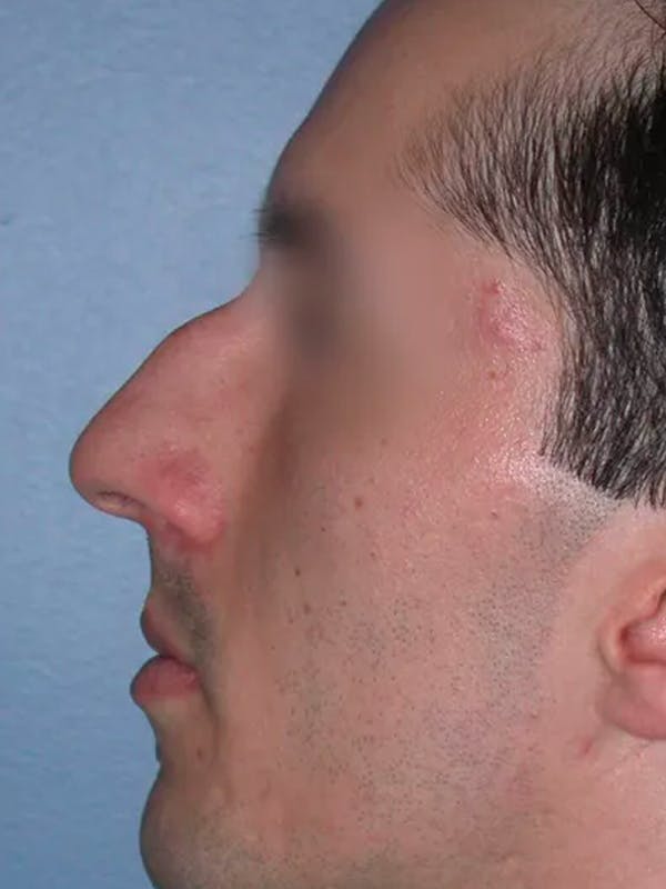 Rhinoplasty Gallery Before & After Gallery - Patient 4757165 - Image 3