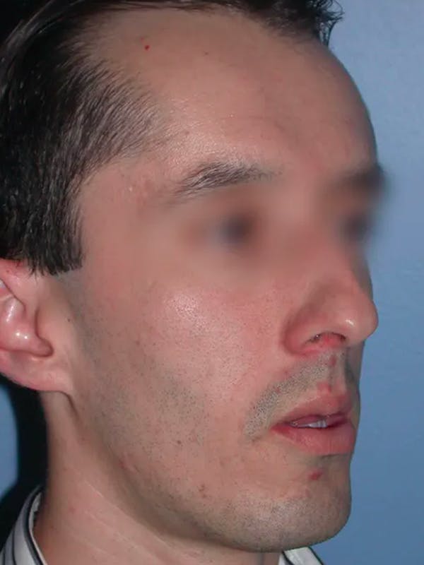Rhinoplasty Gallery Before & After Gallery - Patient 4757165 - Image 5