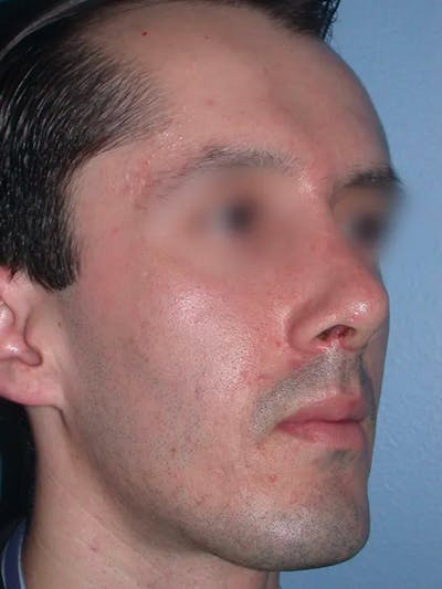 Rhinoplasty Before & After Gallery - Patient 4757165 - Image 6