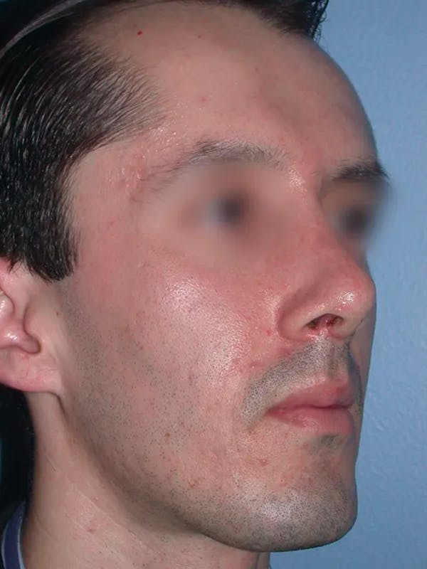 Rhinoplasty Before & After Gallery - Patient 4757165 - Image 6