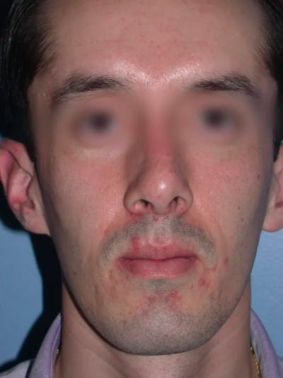 Rhinoplasty Before & After Gallery - Patient 4757165 - Image 8