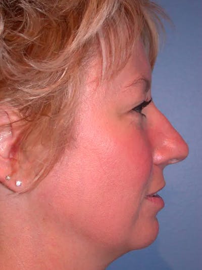 Rhinoplasty Gallery Before & After Gallery - Patient 4757161 - Image 1