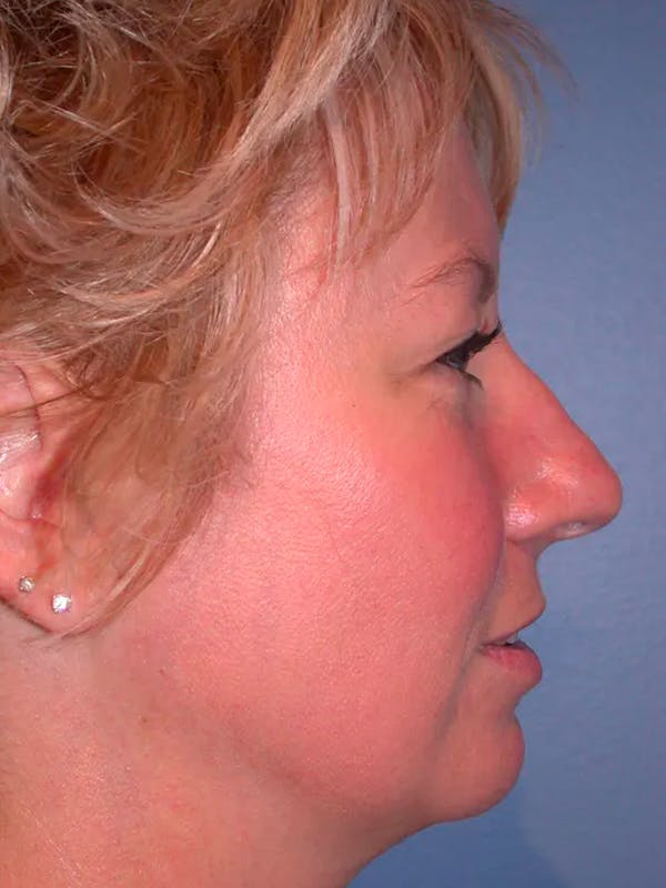 Rhinoplasty Before & After Gallery - Patient 4757161 - Image 1