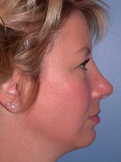 Rhinoplasty Gallery Before & After Gallery - Patient 4757161 - Image 2