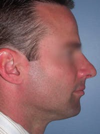 Rhinoplasty Gallery Before & After Gallery - Patient 4757171 - Image 1