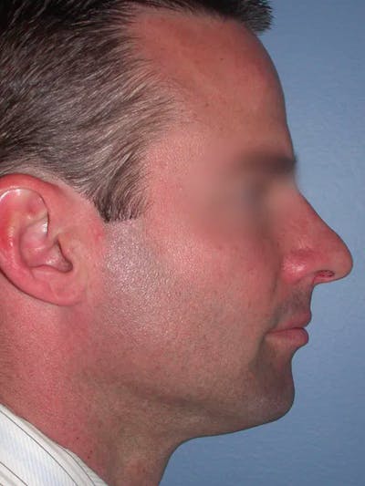 Rhinoplasty Gallery Before & After Gallery - Patient 4757171 - Image 1