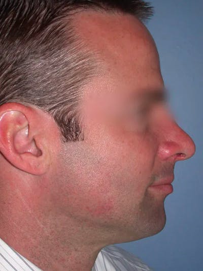 Rhinoplasty Gallery Before & After Gallery - Patient 4757171 - Image 2