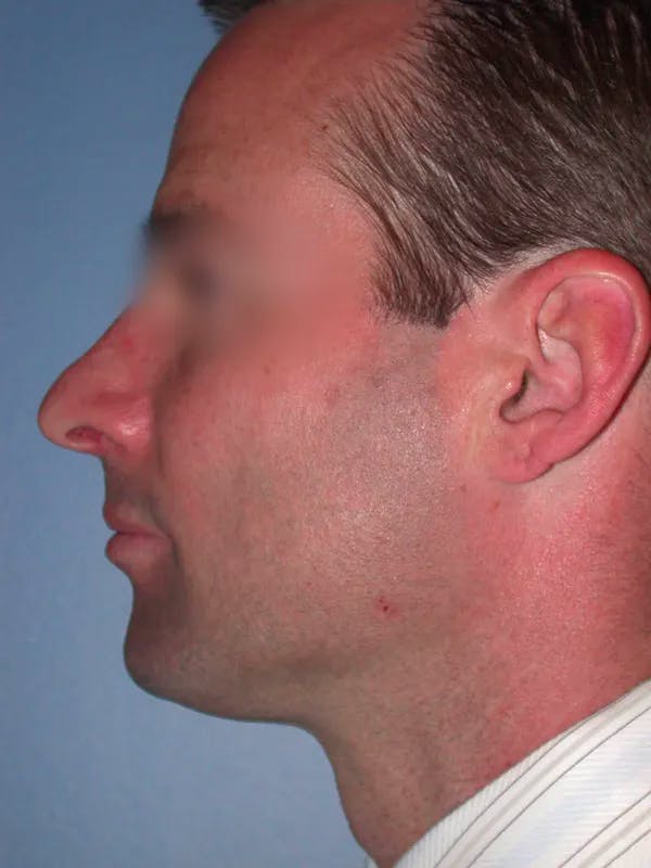 Rhinoplasty Gallery Before & After Gallery - Patient 4757171 - Image 3