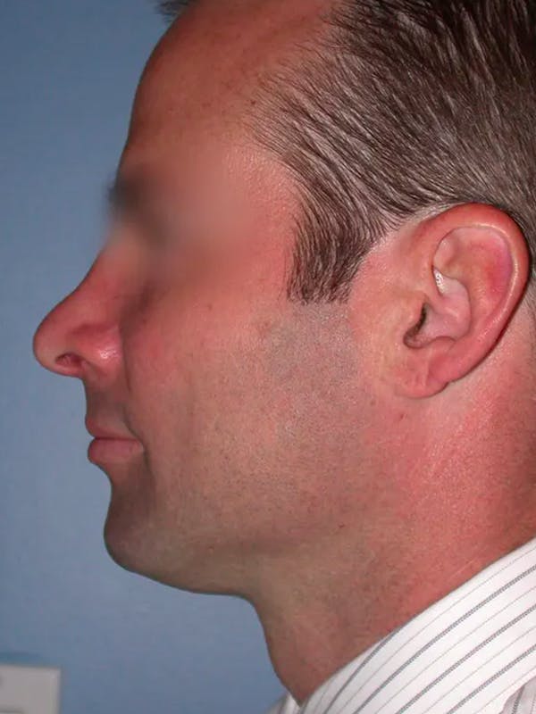 Rhinoplasty Gallery Before & After Gallery - Patient 4757171 - Image 4