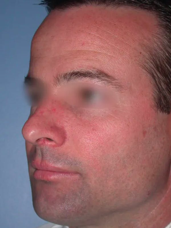 Rhinoplasty Gallery Before & After Gallery - Patient 4757171 - Image 5