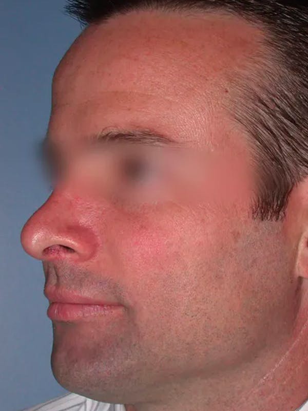 Rhinoplasty Before & After Gallery - Patient 4757171 - Image 6