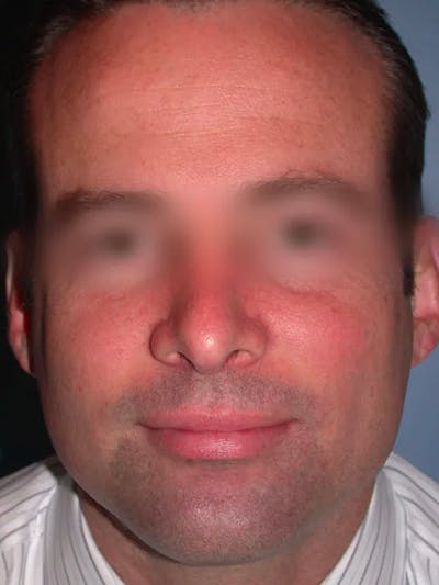 Rhinoplasty Gallery Before & After Gallery - Patient 4757171 - Image 8