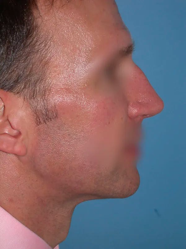 Rhinoplasty Gallery Before & After Gallery - Patient 4757199 - Image 1