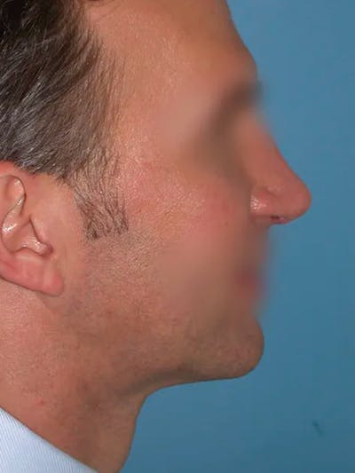 Rhinoplasty Gallery Before & After Gallery - Patient 4757199 - Image 2