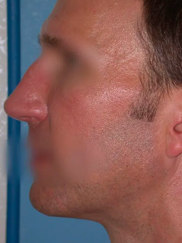 Rhinoplasty Gallery Before & After Gallery - Patient 4757199 - Image 3