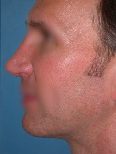 Rhinoplasty Gallery Before & After Gallery - Patient 4757199 - Image 4