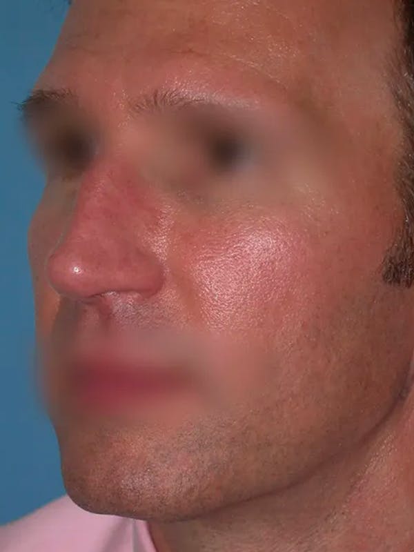 Rhinoplasty Gallery Before & After Gallery - Patient 4757199 - Image 5