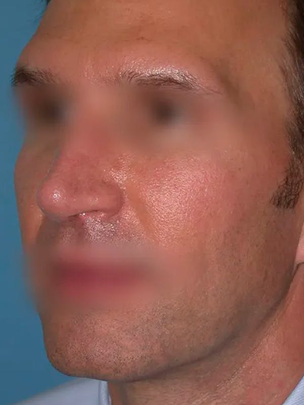 Rhinoplasty Gallery Before & After Gallery - Patient 4757199 - Image 6