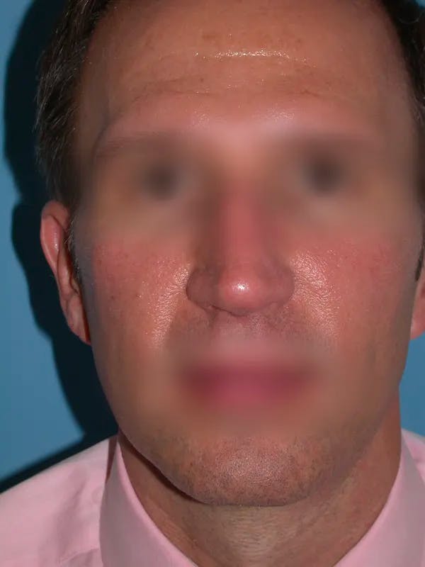 Rhinoplasty Gallery Before & After Gallery - Patient 4757199 - Image 7