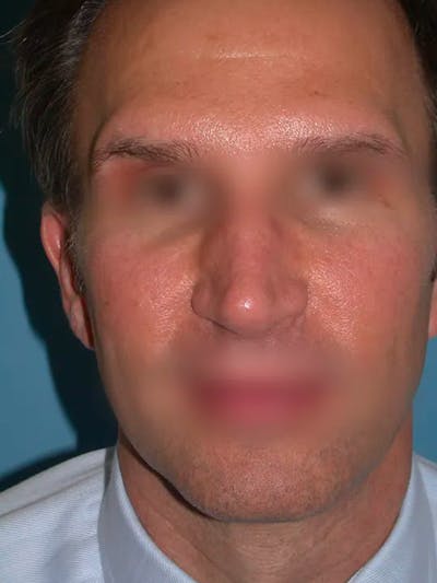 Rhinoplasty Before & After Gallery - Patient 4757199 - Image 8