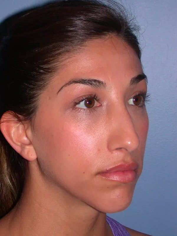 Rhinoplasty Gallery Before & After Gallery - Patient 4757154 - Image 5