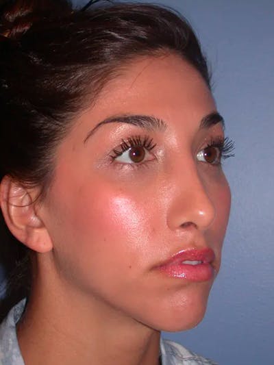 Rhinoplasty Before & After Gallery - Patient 4757154 - Image 6