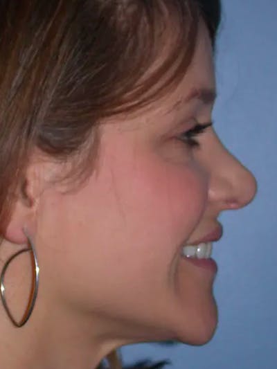 Rhinoplasty Gallery Before & After Gallery - Patient 4757184 - Image 1