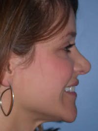 Rhinoplasty Before & After Gallery - Patient 4757184 - Image 1