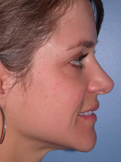 Rhinoplasty Gallery Before & After Gallery - Patient 4757184 - Image 2