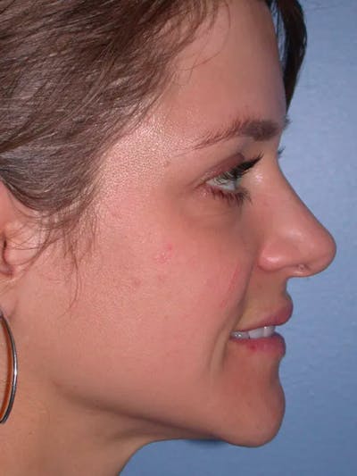 Rhinoplasty Gallery Before & After Gallery - Patient 4757184 - Image 2