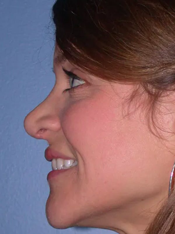 Rhinoplasty Gallery Before & After Gallery - Patient 4757184 - Image 3