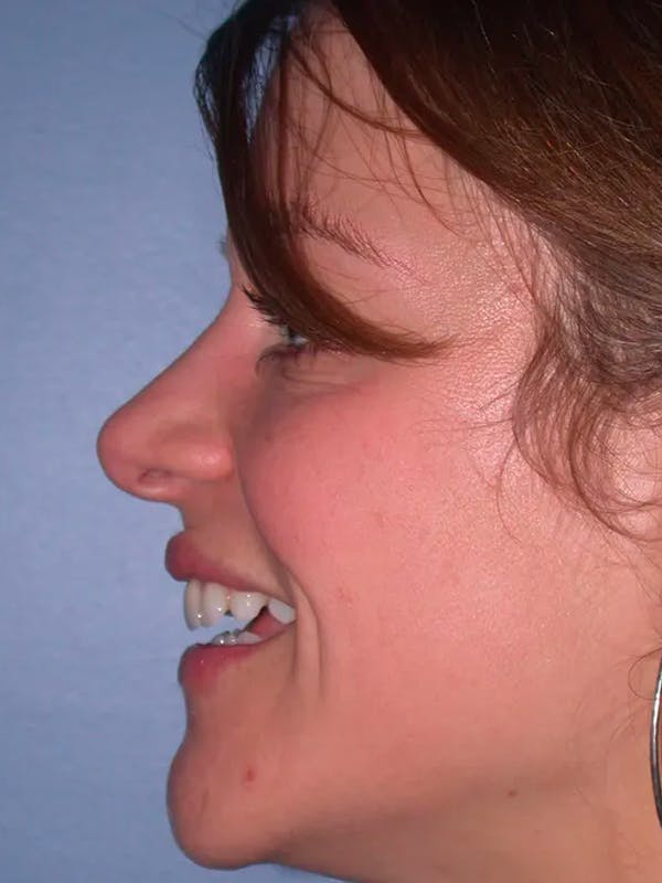 Rhinoplasty Gallery Before & After Gallery - Patient 4757184 - Image 4