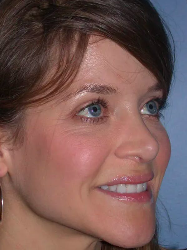 Rhinoplasty Gallery Before & After Gallery - Patient 4757184 - Image 5