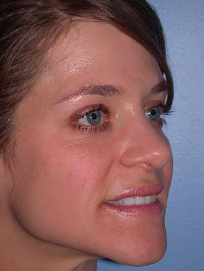 Rhinoplasty Before & After Gallery - Patient 4757184 - Image 6
